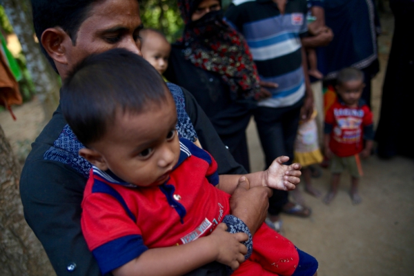 This two-year-old child's hand was badly burnt when Myanmar soldiers set fire to his village